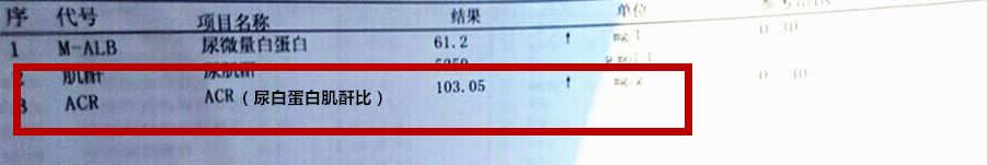 臨床目前最常用尿蛋白肌酐比來(lái)反應(yīng)尿微量白蛋白的水平